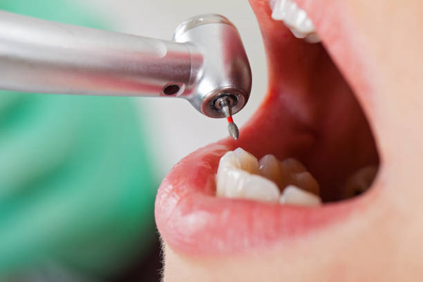 Best Emergency Root Canal Treatment in Summersville, WV
